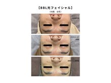 サロン ド クラール(salon de curar)の雰囲気(【BBL光フェイシャルの効果!48歳女性】2回の施術でこの変化!!)
