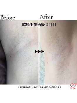 オリオンドットエスツー(Orion.S2)/【Before→After】