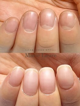マリーロール 梅田店(Marie Laure)/自爪育成/深爪矯正/ネイルケア