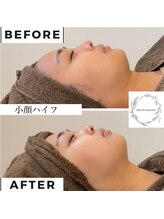 サロン ド パーフェクション(Salon de Perfection)/小顔リフト