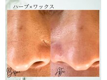 ポノ 茅ヶ崎(Pono.)/茅ケ崎/湘南/脱毛/毛穴/ハーブ