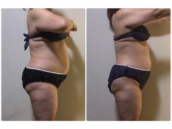 ツボミ(TSUBOMI)/モニター様 before・after