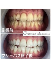 ホワイトニングサロン 京都烏丸店/ホワイトニング施術例