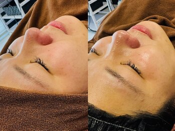 ルーク(Luke)/毛穴ケア