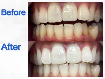 LBSホワイトニング 梅田店/ホワイトニングビフォーアフター