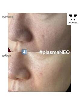 ルミラポー(Lumira Peau)/30代3回