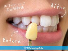 ホワイトニングカフェ 天王寺あべの店(WhiteningCafe)の雰囲気（ホワイトニングの症例写真はフォトギャラリーで多数紹介★）