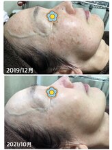 ビエル(Bielle)/シミ改善・透明感あるツヤ白肌へ