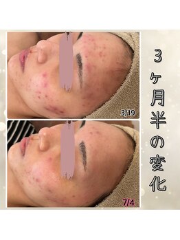 プルーム 大橋店(plume)/ハーブピーリング