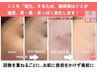 【年齢肌にプラズマ革命】シミケア放題×幹細胞エステで肌の土台から若々しく
