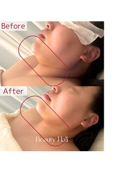 エクリア(ECLIA)/レッドショット2cc×EMS