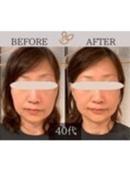 チョコバリ 錦糸町店(chocobari)/小顔×リフトアップ(美容鍼)40代