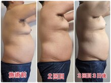 ココロ(Cocoro)/グロッティ脂肪分解３回での変化