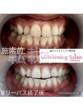 ホワイトニングサロン 福岡博多店/ホワイトニング