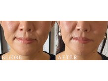 ロジワール(LOISIR)/フェイスラインの印象変化1回目