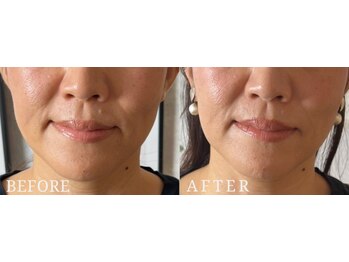 ロジワール(LOISIR)/フェイスラインの印象変化1回目