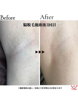 オリオンドットエスツー(Orion.S2)/【Before→After】