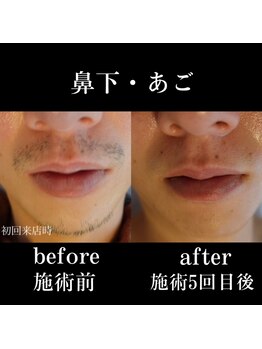 メンテ(MENTE)/ヒゲ脱毛ならMENTEまで