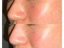 ル シーニュ/毛穴洗浄×スノーピール