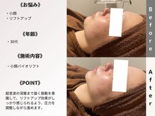 ルディラ 新宿店/小顔バイオリフト