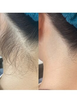 プライベートサロン結/うなじのシェービング