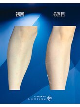 ルミーク(Lumique)/ひざ下6回目 症例 O様