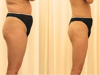 ファニービー 吹田店/下半身が気になるあなたへ