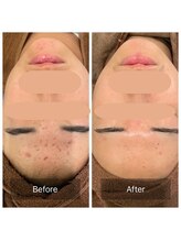 毛穴屋/ハーブピーリングで肌質改善◎