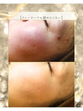 スノースキン(Snow skin)/ニキビケア/ハーブピーリング