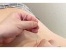 【姿勢改善♪猫背矯正コース 】鍼灸施術◎ 60分 ¥5,980