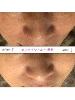 キュオバイアンドリープ(Qo by &LEAP)/光フェイシャル/beforeafter