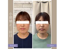 キアラ(chiara)の雰囲気（小顔矯正（3回目）のビフォーアフターのお写真です☆）