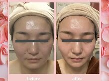 リリー ボヌール(Lily bonheur)/恋のア・モーレリフト美顔