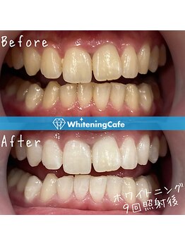 ホワイトニングカフェ イオン新潟青山店(WhiteningCafe)/