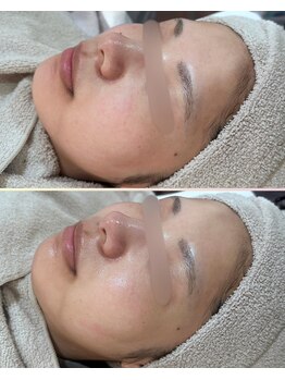 ソワナ(soina)/【神楽坂駅/フェイシャル/毛穴】