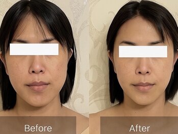ムーン(Moon)/ビフォーアフター/小顔リフト