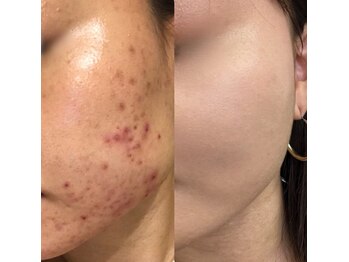 サロンドゥルシェル(salonde_le ciel)の写真/人気No.1ハーブリプロ!繰り返す肌荒れや、ニキビにお悩みの方◎・毛穴・シミ・たるみなど、全てのお悩みに