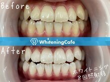ホワイトニングカフェ赤羽店/ホワイトニングビフォーアフター