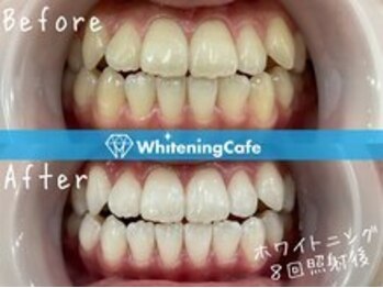 ホワイトニングカフェ赤羽店/ホワイトニングビフォーアフター