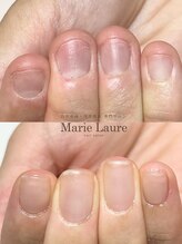 マリーロール 梅田店(Marie Laure)/自爪育成/深爪矯正/ネイルケア