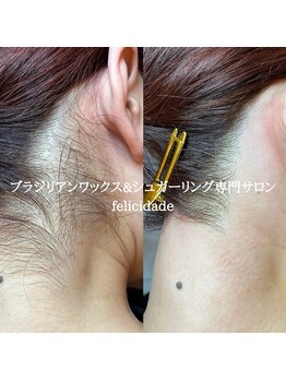 フェリシダージ(felicidade)/うなじ脱毛★