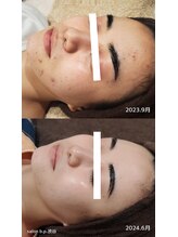 ビーピー 渋谷(b.p.)/ハーブピーリング　ニキビケア