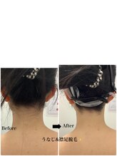 メディカルサロンドオフ 堺東店(medical salon de off)/うなじ襟足脱毛♪