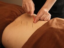 ハリラックス(HA:Ri/LAX)/【身体鍼灸の様子】