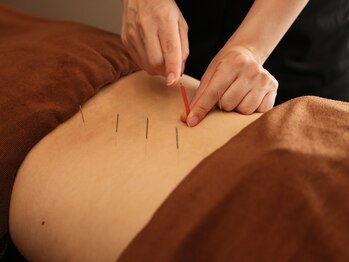 ハリラックス(HA:Ri/LAX)/【身体鍼灸の様子】