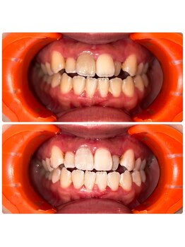 コナホワイトニング 神保町/ホワイトニング