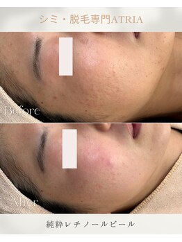 アトリア(ATRIA)/純粋レチノールピール