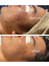 インチャント 四万十店(enchant)/メンズのニキビケアもお任せ