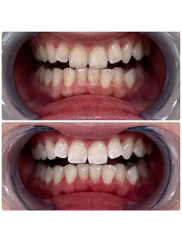 エクシアホワイトニング 日本橋店/セルフホワイトニング