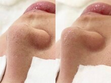 レディ(Lady)/毛穴洗浄★ハイドロフェイシャル